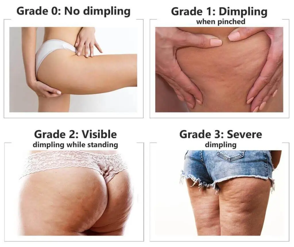 Representation of the stages of cellulite development Avonmouth